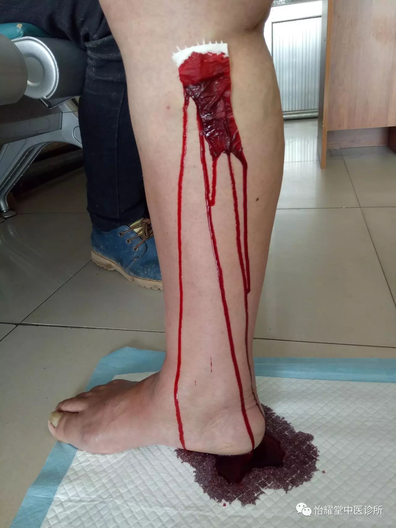 小腿放血位置示意图图片