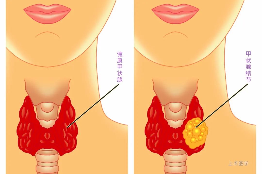 甲狀腺結節會癌變嗎什麼情況下需要切除