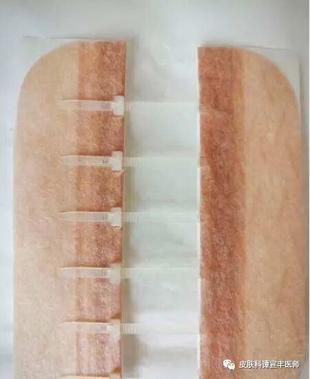 为什么要用皮肤缝合器术后护理（二）要让伤口变细，减张是关键_https://www.jmylbn.com_新闻资讯_第4张