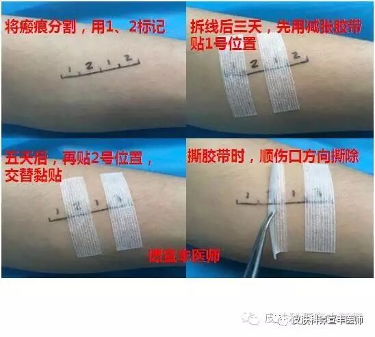 为什么要用皮肤缝合器术后护理（二）要让伤口变细，减张是关键_https://www.jmylbn.com_新闻资讯_第2张