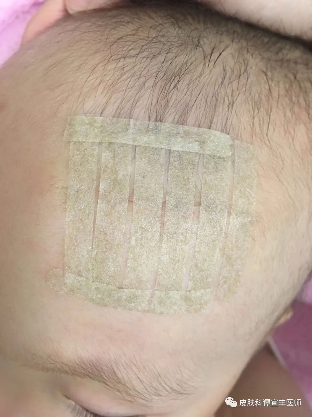 为什么要用皮肤缝合器术后护理（二）要让伤口变细，减张是关键_https://www.jmylbn.com_新闻资讯_第3张