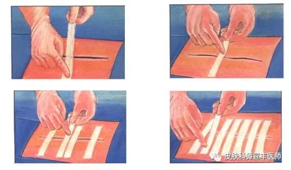 为什么要用皮肤缝合器术后护理（二）要让伤口变细，减张是关键_https://www.jmylbn.com_新闻资讯_第1张