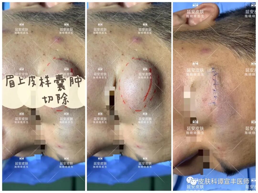 最精细手术是什么皮外同道手术案例分享（49）｜ 精细小手术19个，哪个让你最惊艳？-上海聚慕医疗器械有限公司