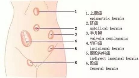 疝气补片怎么固定【腹腔镜篇】疝修补术——疝气的最佳手术方式_https://www.jmylbn.com_新闻资讯_第2张