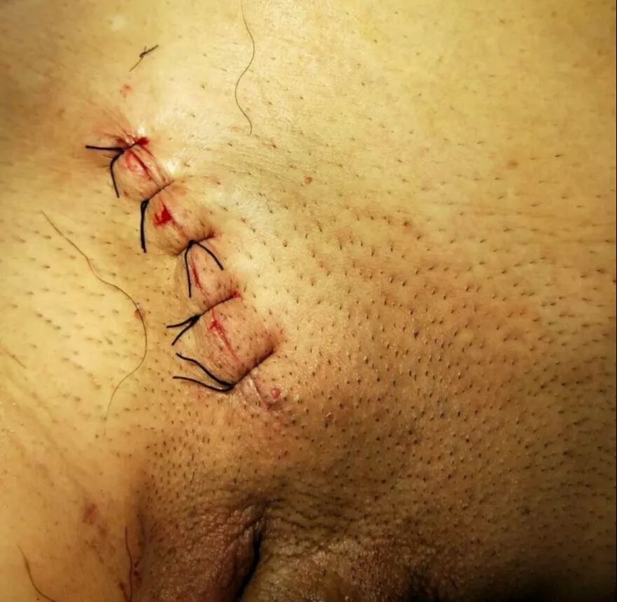 疝气补片怎么固定【腹腔镜篇】疝修补术——疝气的最佳手术方式_https://www.jmylbn.com_新闻资讯_第4张