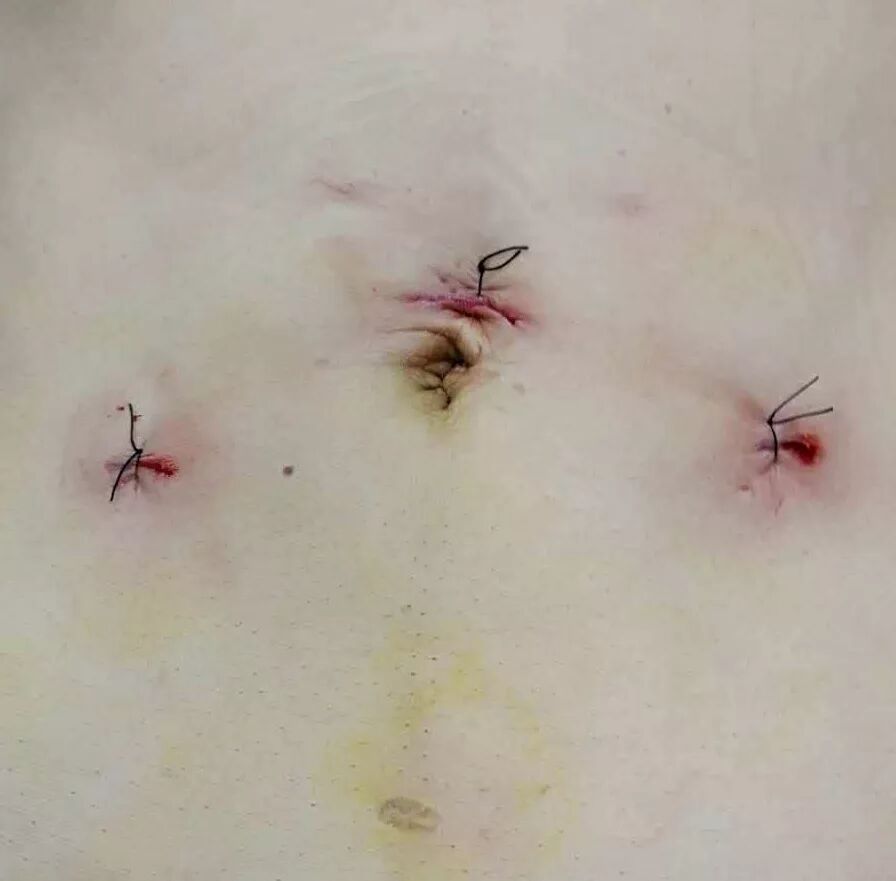 疝气补片怎么固定【腹腔镜篇】疝修补术——疝气的最佳手术方式_https://www.jmylbn.com_新闻资讯_第3张