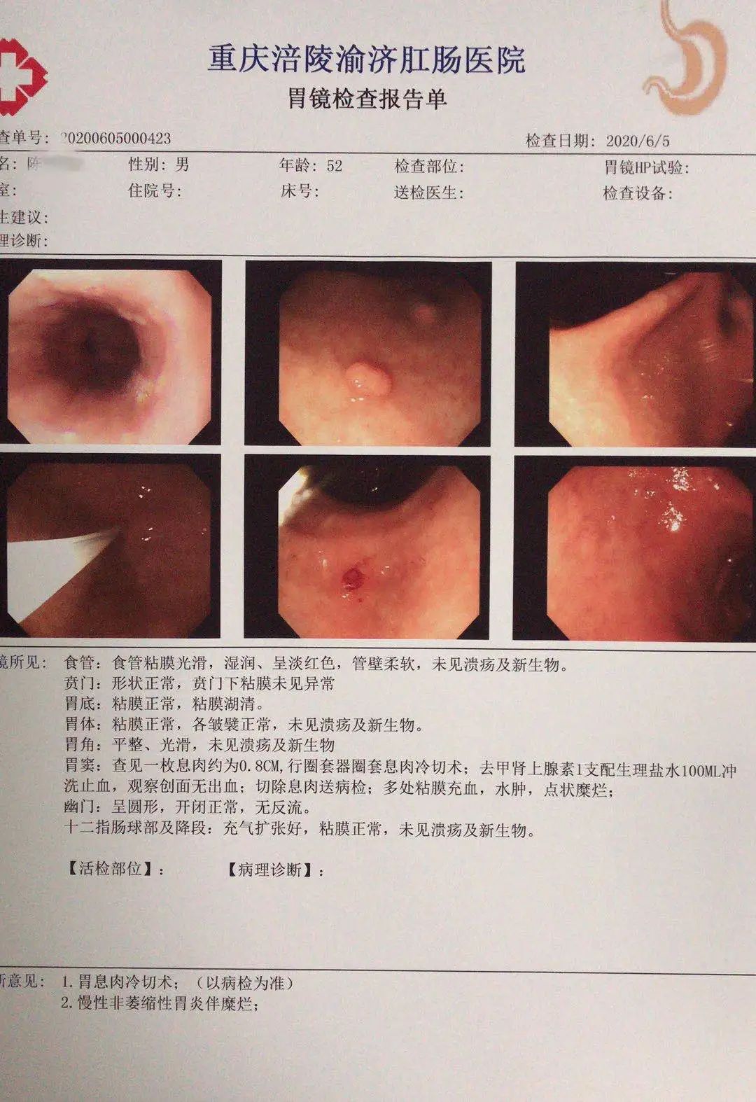 此，陈某还存在慢性非萎缩性胃炎伴糜烂等问题。（胃镜检查出的胃息肉）