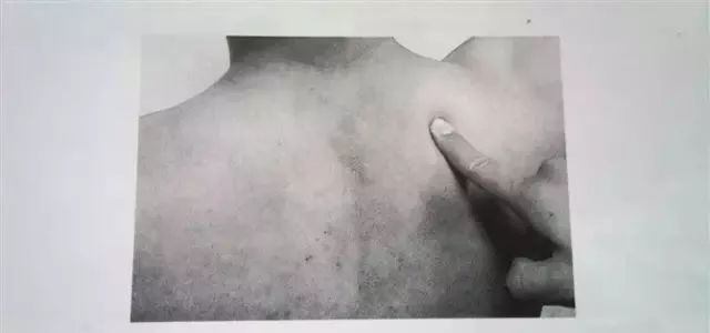 外展枕怎么使用干货 ｜ 针刀治疗要点规程定点定位_https://www.jmylbn.com_新闻资讯_第35张