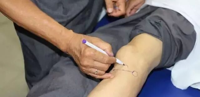 外展枕怎么使用干货 ｜ 针刀治疗要点规程定点定位_https://www.jmylbn.com_新闻资讯_第2张