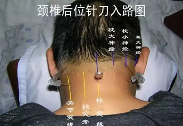 外展枕怎么使用干货 ｜ 针刀治疗要点规程定点定位_https://www.jmylbn.com_新闻资讯_第4张