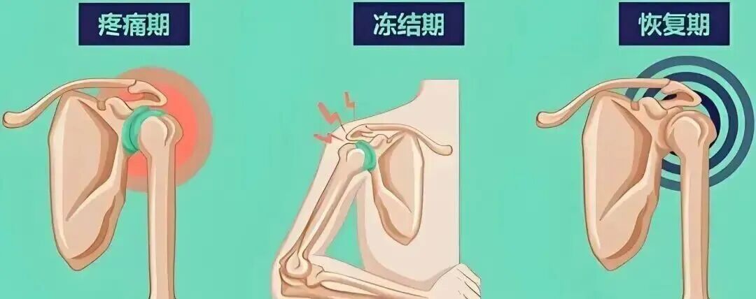 中频为什么能镇痛肩周炎（冻结肩）的综合诊疗思路_https://www.jmylbn.com_新闻资讯_第10张