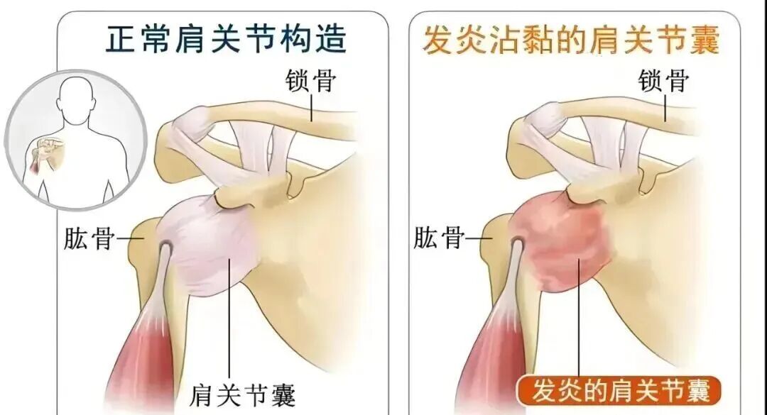 中频为什么能镇痛肩周炎（冻结肩）的综合诊疗思路_https://www.jmylbn.com_新闻资讯_第12张