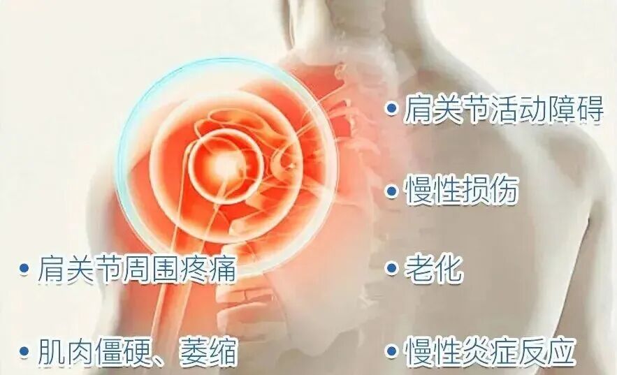 中频为什么能镇痛肩周炎（冻结肩）的综合诊疗思路_https://www.jmylbn.com_新闻资讯_第2张