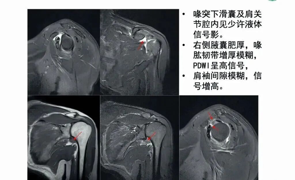中频为什么能镇痛肩周炎（冻结肩）的综合诊疗思路_https://www.jmylbn.com_新闻资讯_第13张