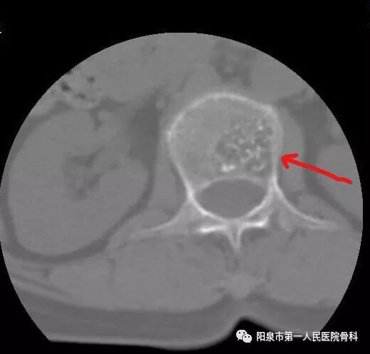 椎体成型需要哪些器材椎体成形术概述_https://www.jmylbn.com_新闻资讯_第14张