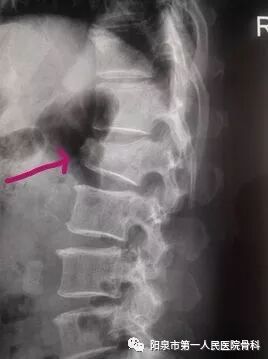 椎体成型需要哪些器材椎体成形术概述_https://www.jmylbn.com_新闻资讯_第12张