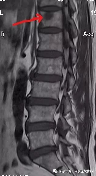 椎体成型需要哪些器材椎体成形术概述_https://www.jmylbn.com_新闻资讯_第15张