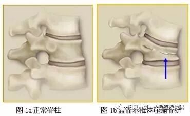 椎体成型需要哪些器材椎体成形术概述_https://www.jmylbn.com_新闻资讯_第11张