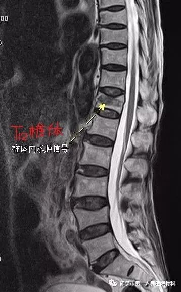 椎体成型需要哪些器材椎体成形术概述_https://www.jmylbn.com_新闻资讯_第13张