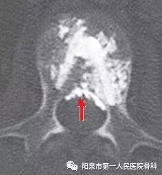 椎体成型需要哪些器材椎体成形术概述_https://www.jmylbn.com_新闻资讯_第36张