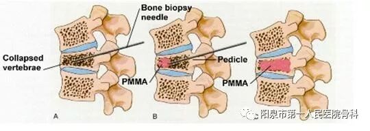 椎体成型需要哪些器材椎体成形术概述_https://www.jmylbn.com_新闻资讯_第34张