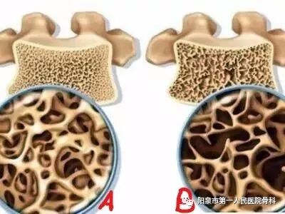 椎体成型需要哪些器材椎体成形术概述_https://www.jmylbn.com_新闻资讯_第33张