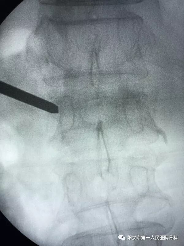 椎体成型需要哪些器材椎体成形术概述_https://www.jmylbn.com_新闻资讯_第25张