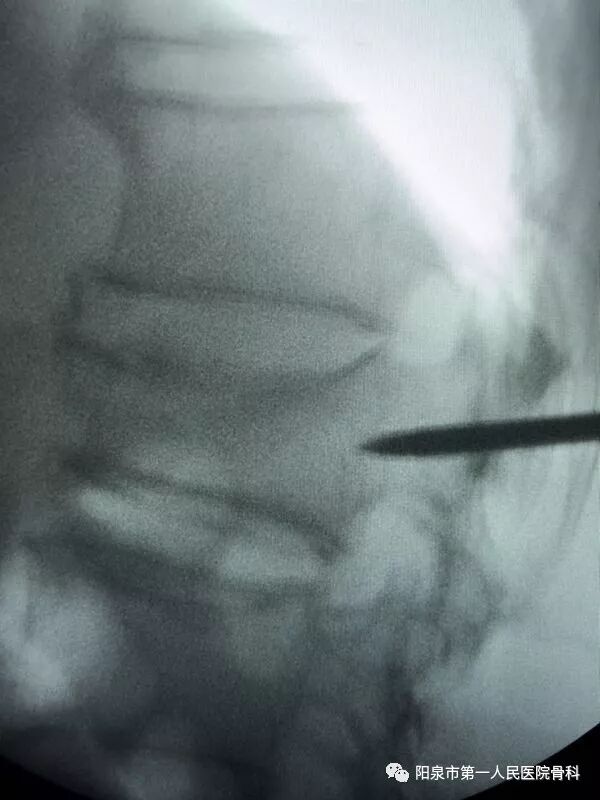 椎体成型需要哪些器材椎体成形术概述_https://www.jmylbn.com_新闻资讯_第26张