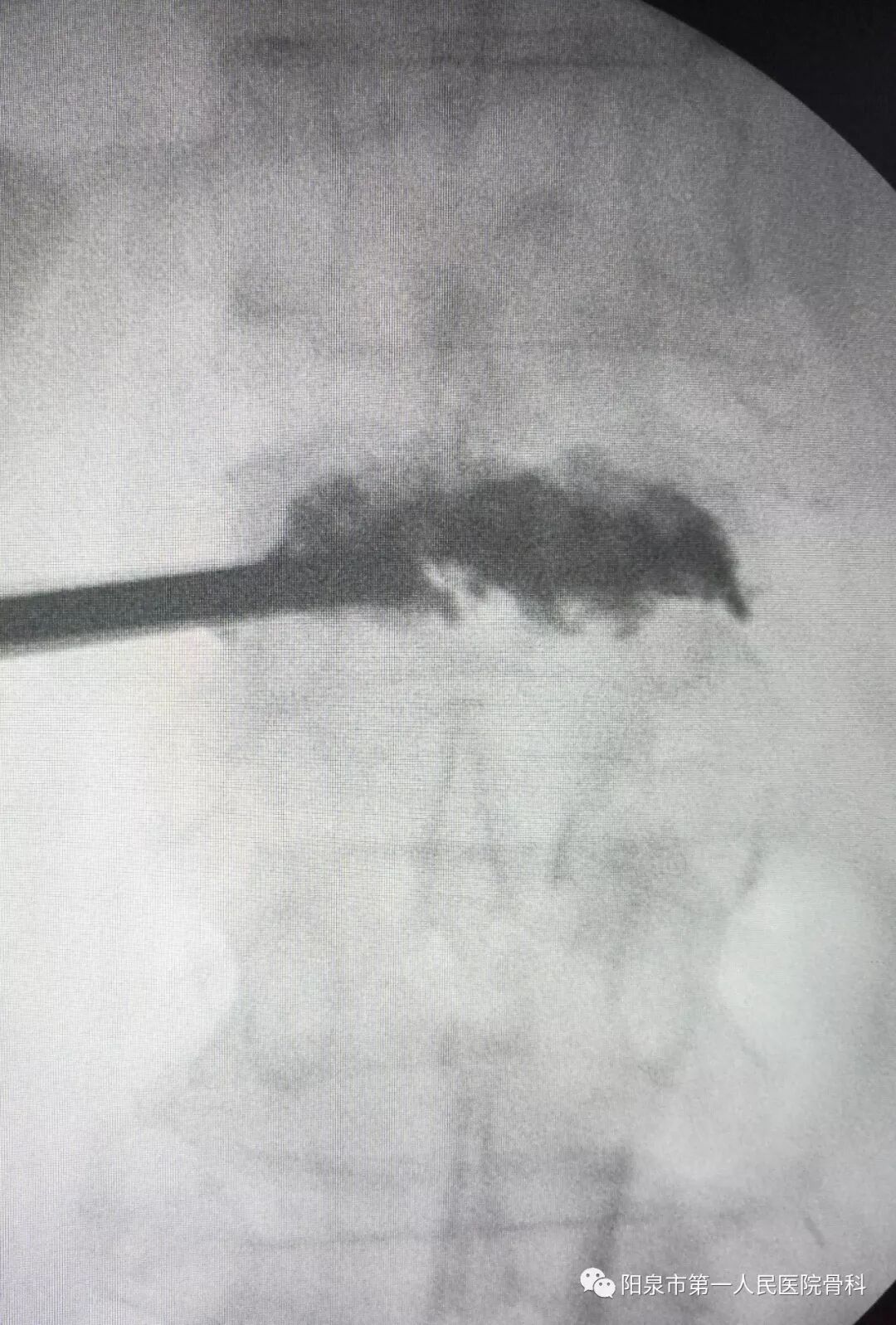 椎体成型需要哪些器材椎体成形术概述_https://www.jmylbn.com_新闻资讯_第29张
