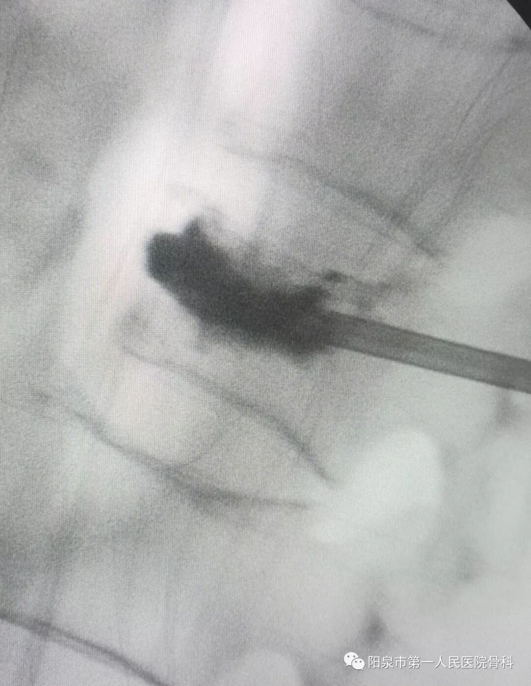 椎体成型需要哪些器材椎体成形术概述_https://www.jmylbn.com_新闻资讯_第30张