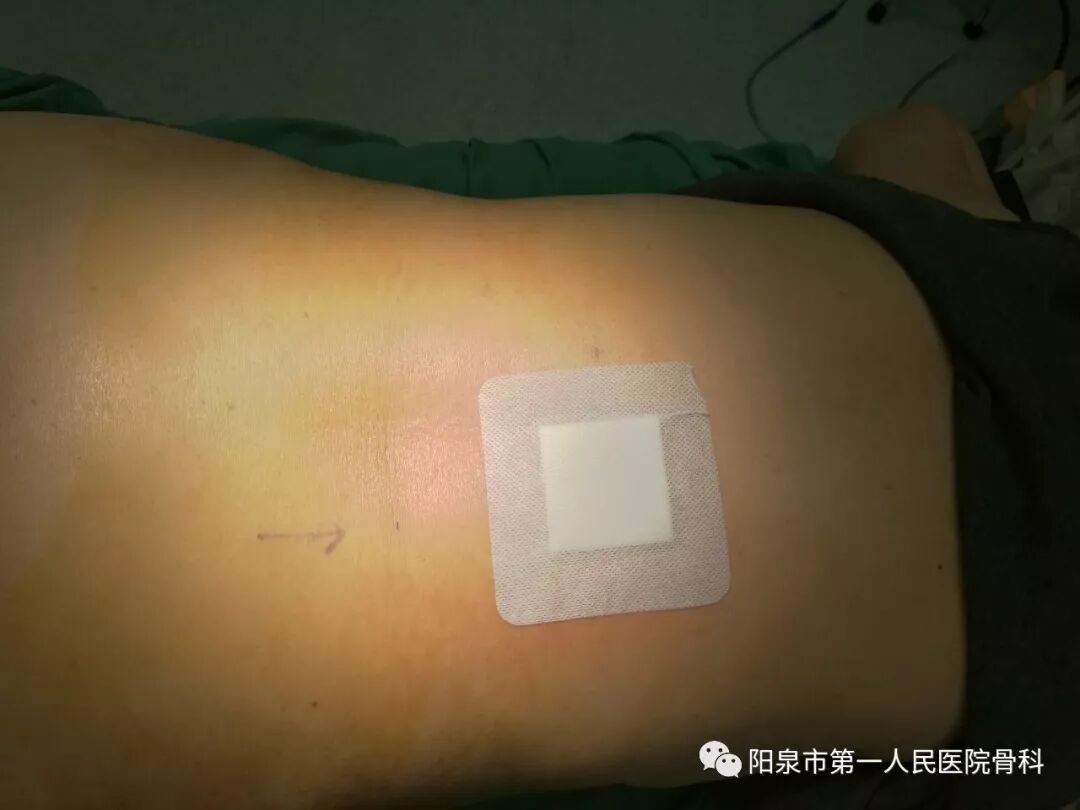 椎体成型需要哪些器材椎体成形术概述_https://www.jmylbn.com_新闻资讯_第32张