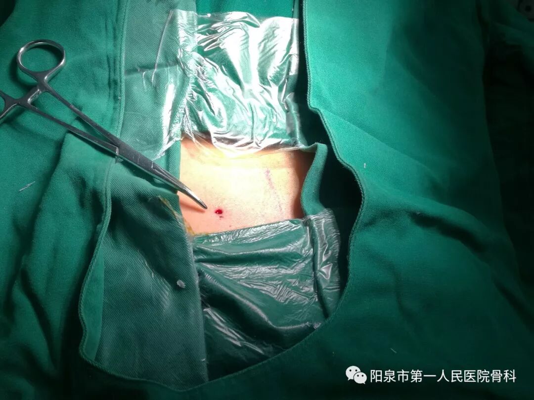 椎体成型需要哪些器材椎体成形术概述_https://www.jmylbn.com_新闻资讯_第31张