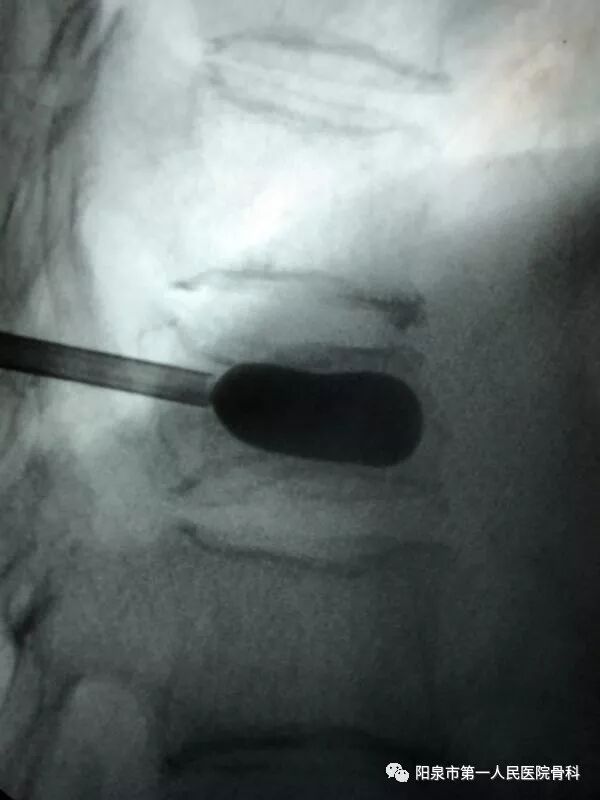 椎体成型需要哪些器材椎体成形术概述_https://www.jmylbn.com_新闻资讯_第28张