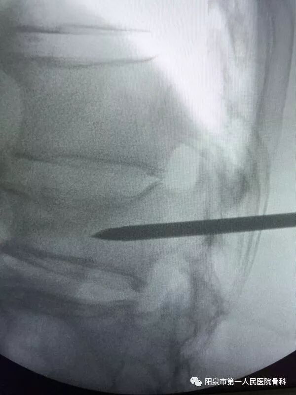 椎体成型需要哪些器材椎体成形术概述_https://www.jmylbn.com_新闻资讯_第27张