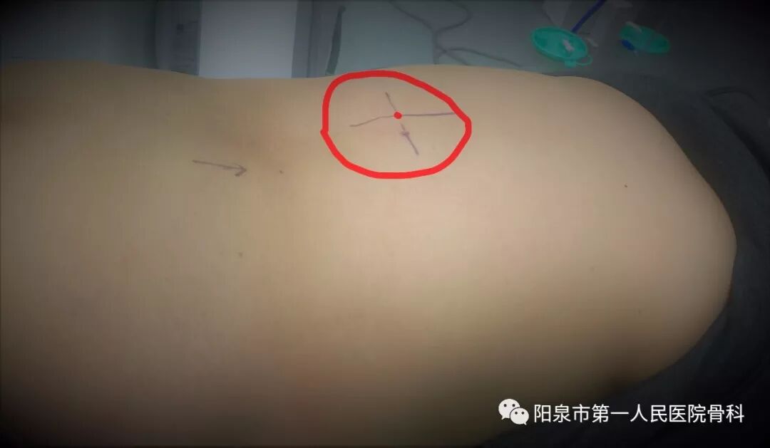 椎体成型需要哪些器材椎体成形术概述_https://www.jmylbn.com_新闻资讯_第20张