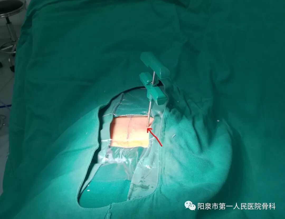 椎体成型需要哪些器材椎体成形术概述_https://www.jmylbn.com_新闻资讯_第24张