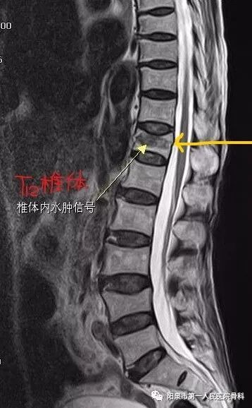 椎体成型需要哪些器材椎体成形术概述_https://www.jmylbn.com_新闻资讯_第16张