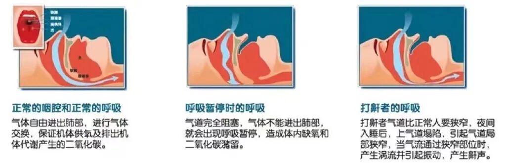 呼吸机怎么选择【健康星期天】畅快呼吸、倍感轻松——无创呼吸机的正确选择_https://www.jmylbn.com_新闻资讯_第9张