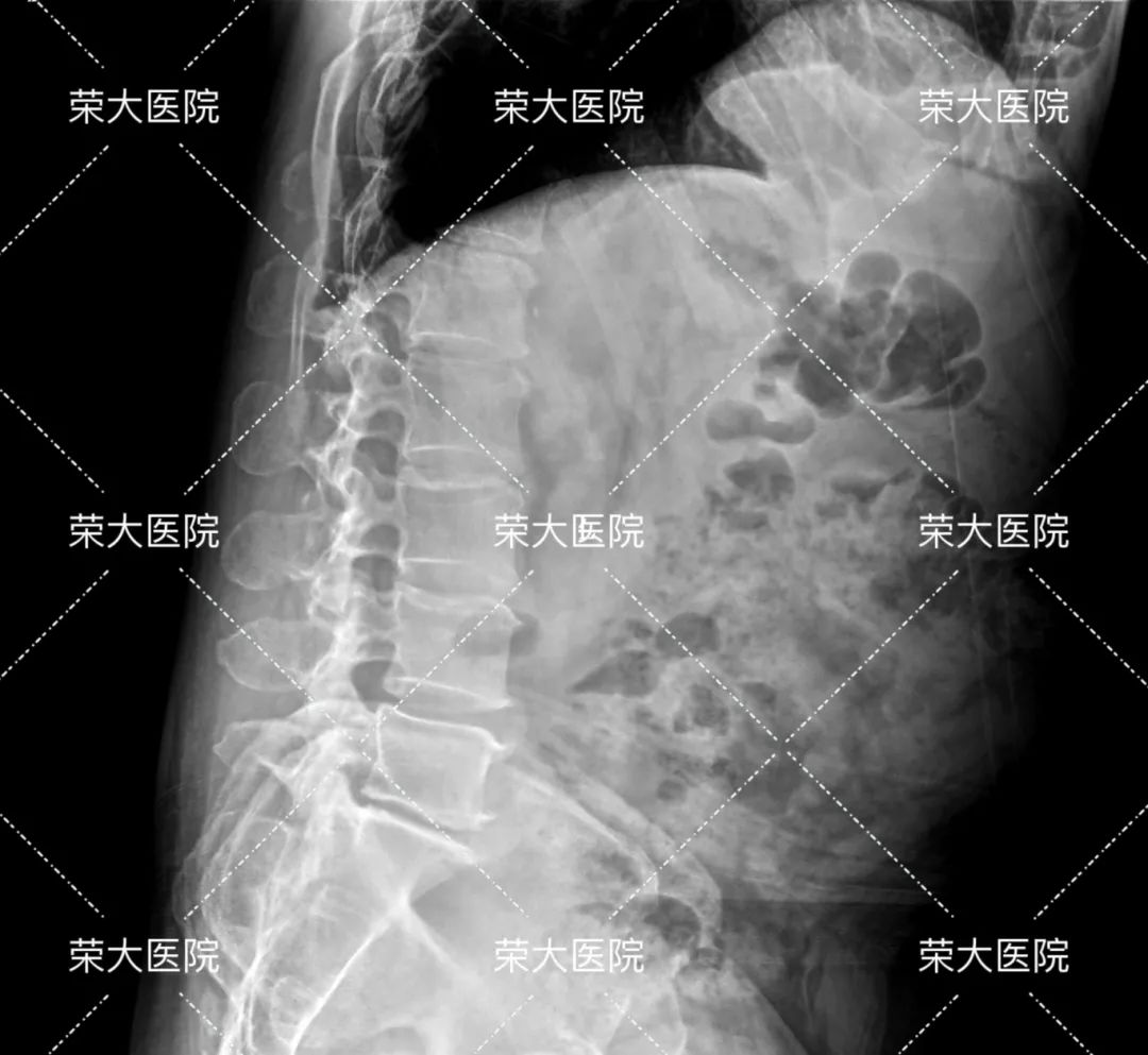 80%腰突保守治疗能缓解，但吴先生手术了