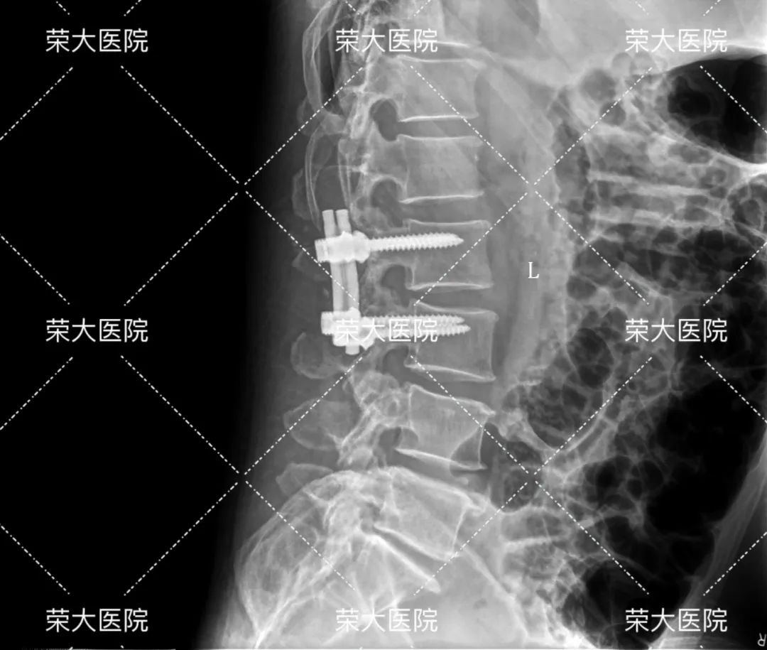 80%腰突保守治疗能缓解，但吴先生手术了