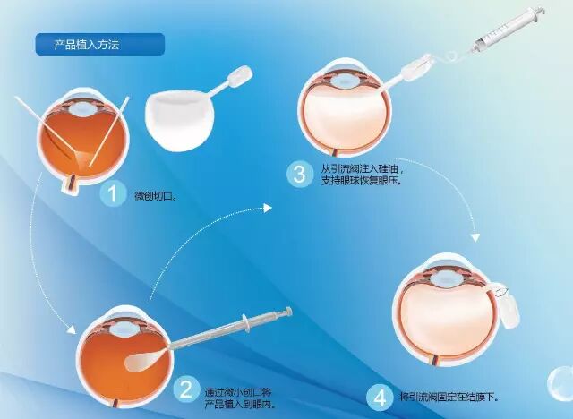 折叠式人工玻璃体球囊