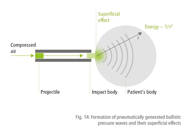 压力波是什么波关于洽圩压力波治疗仪的总结_https://www.jmylbn.com_新闻资讯_第3张