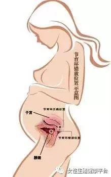 惊!胎儿头上套了“紧箍咒”?怀孕前,这件事一定要注意!