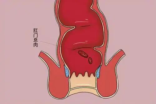 痔瘡與肛門息肉的區別是什麼?(圖1)