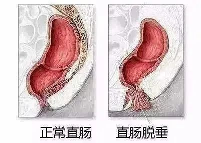 如何分辨肛門脫出的肉疙瘩是痔瘡,還是直腸脫垂?