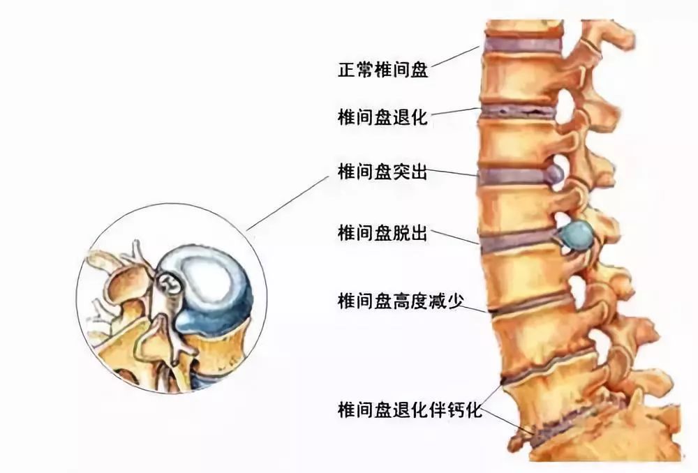 腰间盘突出的症状及自我康复疗法