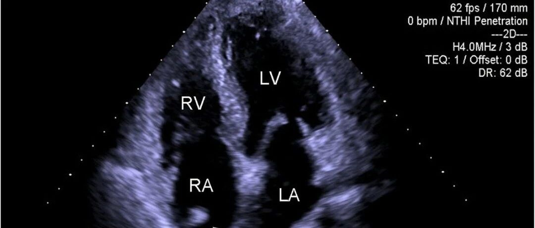 心脏超声示「舒张功能不全」，要不要治？