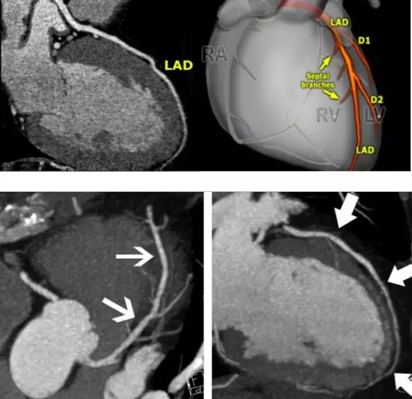 左前降支 lad:lad 走形在室间沟内,至心尖.