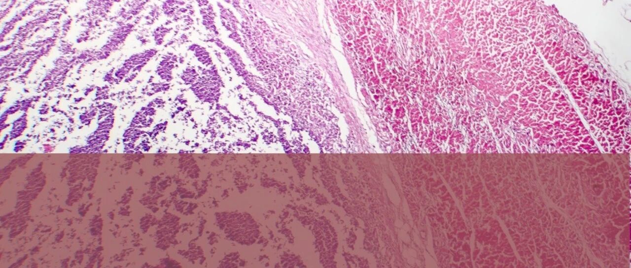 这种致死率最高达 67% 的心肌炎，应如何安全用药？