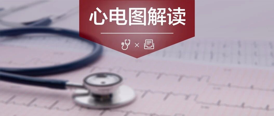遇到 T 波倒置如何分析？这个原因 99% 的医生都会忽略！